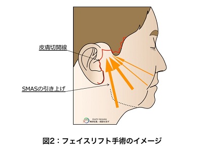 フェイスリフト手術のイメージ