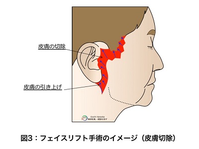 フェイスリフト手術のイメージ（皮膚切除）