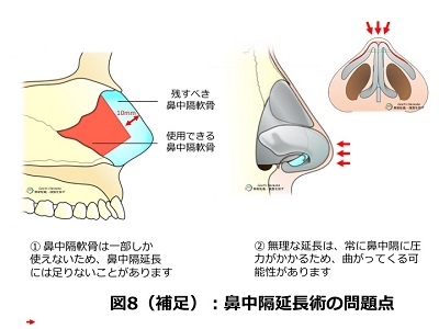 鼻中隔延長術の問題点（補足）