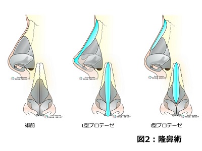 鼻の整形・隆鼻術