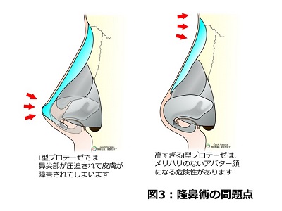 シリコンプロテーゼ隆鼻術