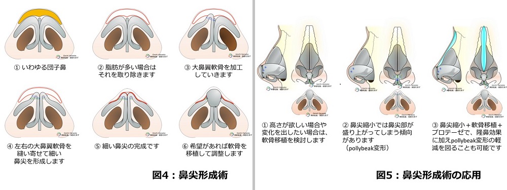 鼻尖形成術 鼻の整形 神戸大学医学部附属病院 美容外科 Kobe Univercity Hospital Aethetic Surgery