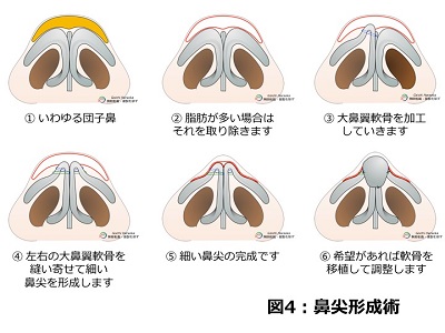 鼻尖形成術