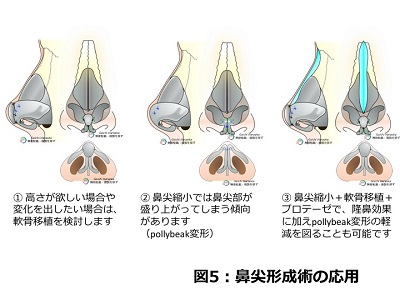 鼻尖形成の応用