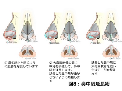 鼻中隔延長術