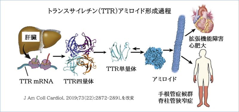 不安定なTTRが疾患を惹起する過程。