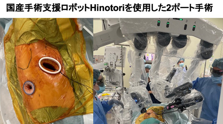 肺悪性腫瘍に対するロボット支援内視鏡手術