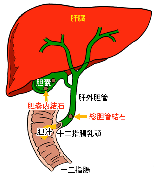 腹腔鏡下胆嚢摘出術