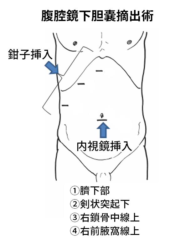 腹腔鏡下胆嚢摘出術