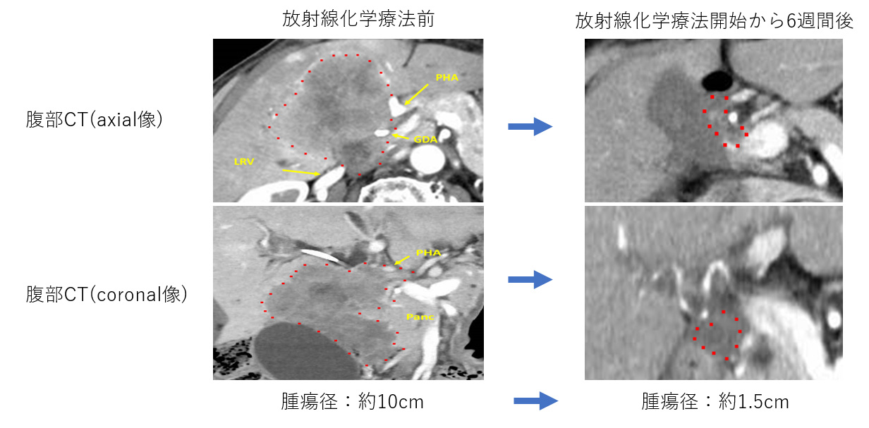 肝門部巨大腫瘍