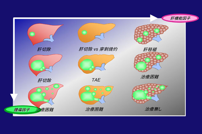 肝細胞がんに対する神戸戦略
