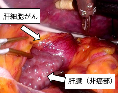 腹腔鏡下肝切除術