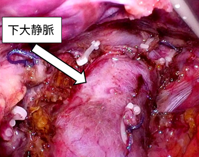 腹腔鏡下肝切除術