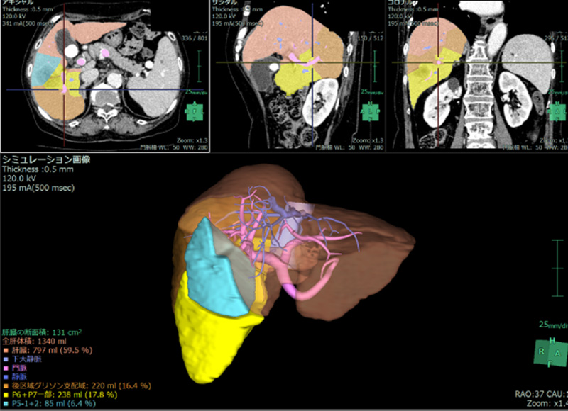 画像支援ソフトを用いた術前シミュレーション