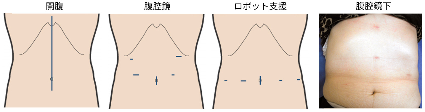 膵体尾部切除の創部