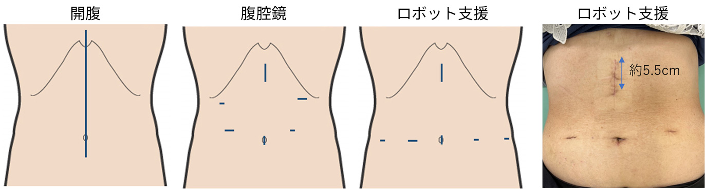 膵頭十二指腸切除の創部