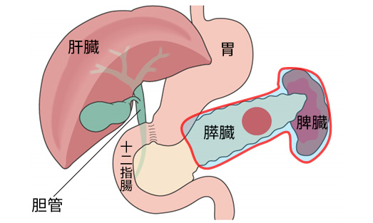 膵体尾部切除