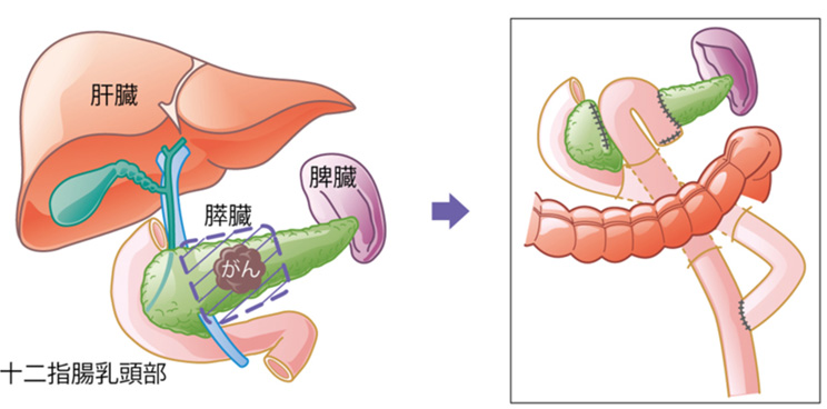 膵中央切除