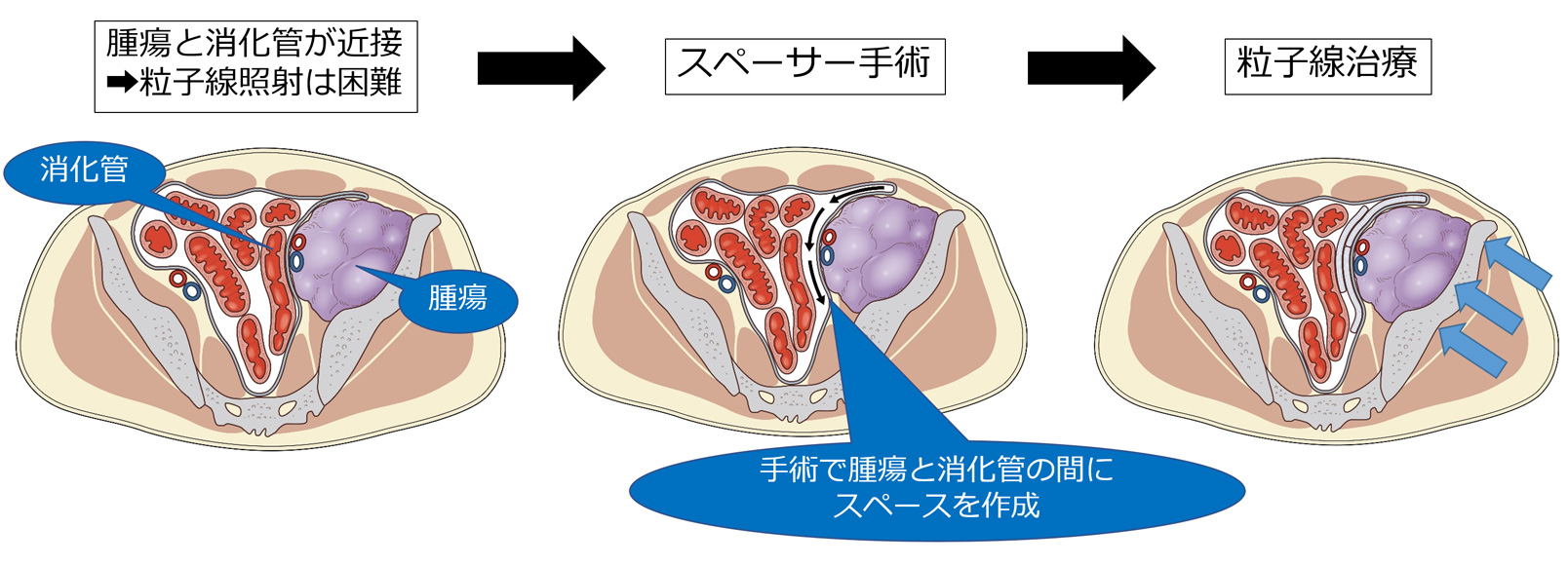 腹部悪性腫瘍に対するスペーサー手術