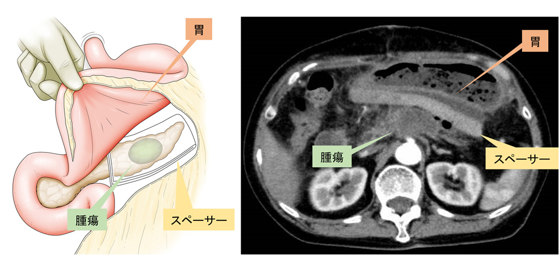 膵体部癌に対する生体吸収性スペーサー留置＋粒子線治療