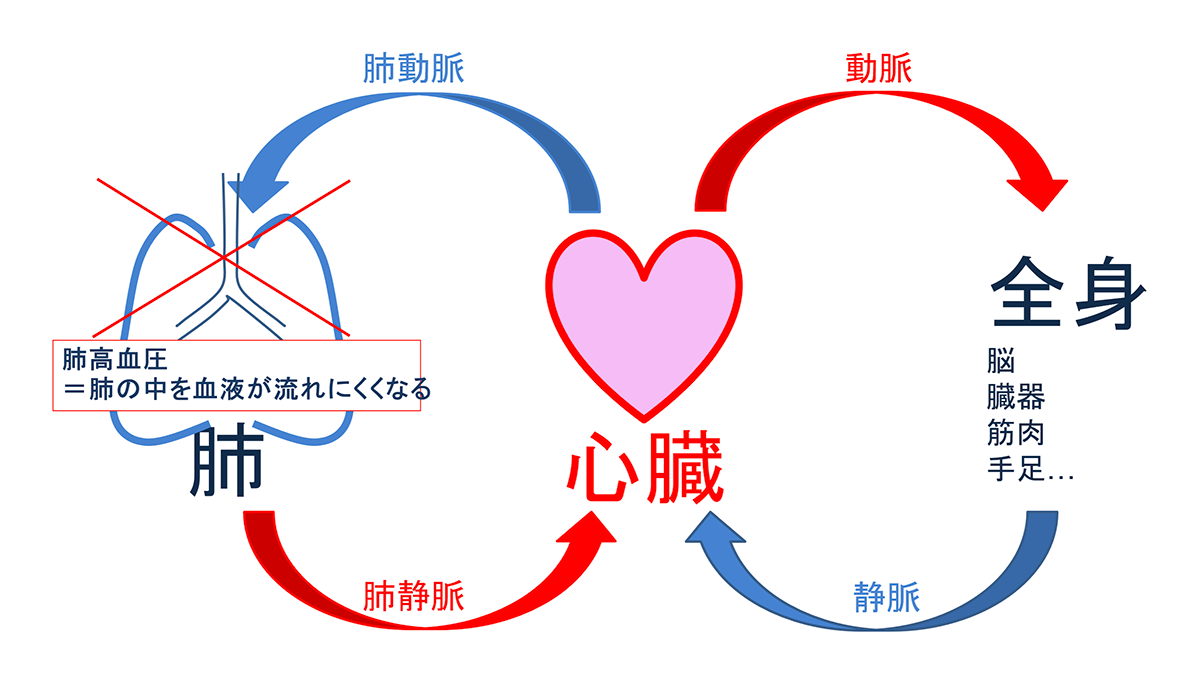 肺高血圧症とは?