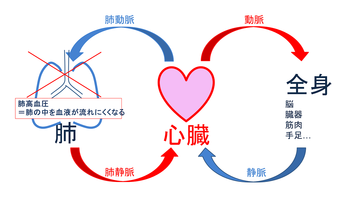 肺高血圧症とは？