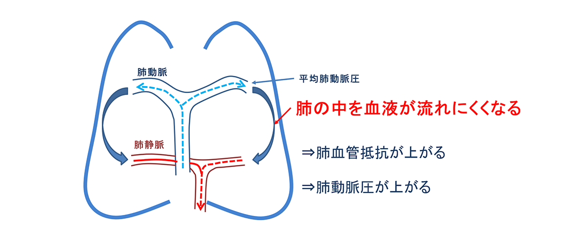 肺動脈の圧が上がる