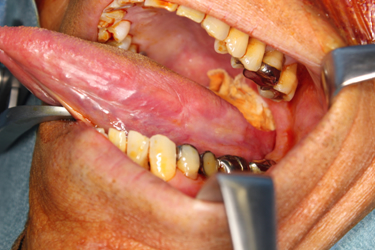 顎口腔領域腫瘍に対する再建を含めた治療