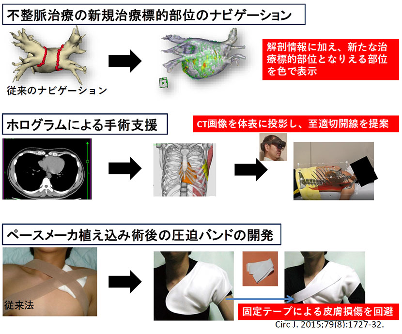 不整脈治療の新規治療標的部位のナビゲーション/ホログラムによる手術支援/ペースメーカー植え込み術後の圧迫バンドの開発