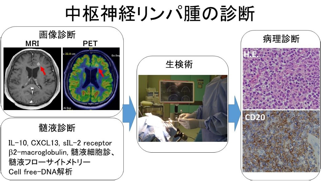 中枢神経悪性リンパ腫の診断