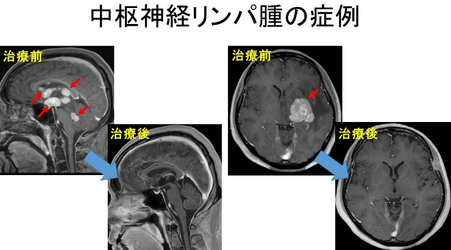 中枢神経悪性リンパ腫の症例