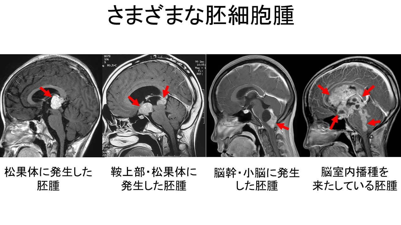 さまざまな胚細胞腫瘍