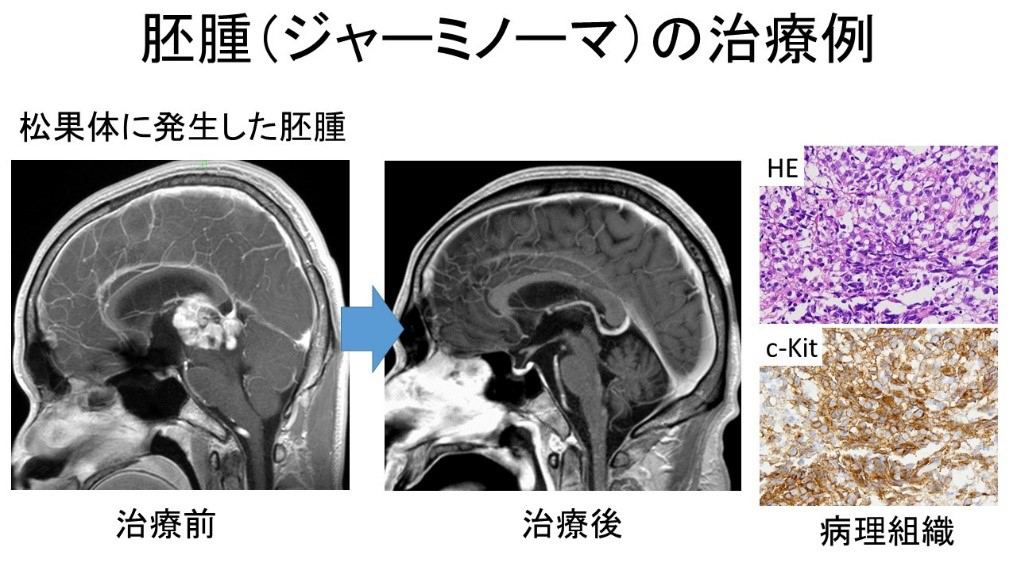 胚腫（ジャーミノーマの治療例）