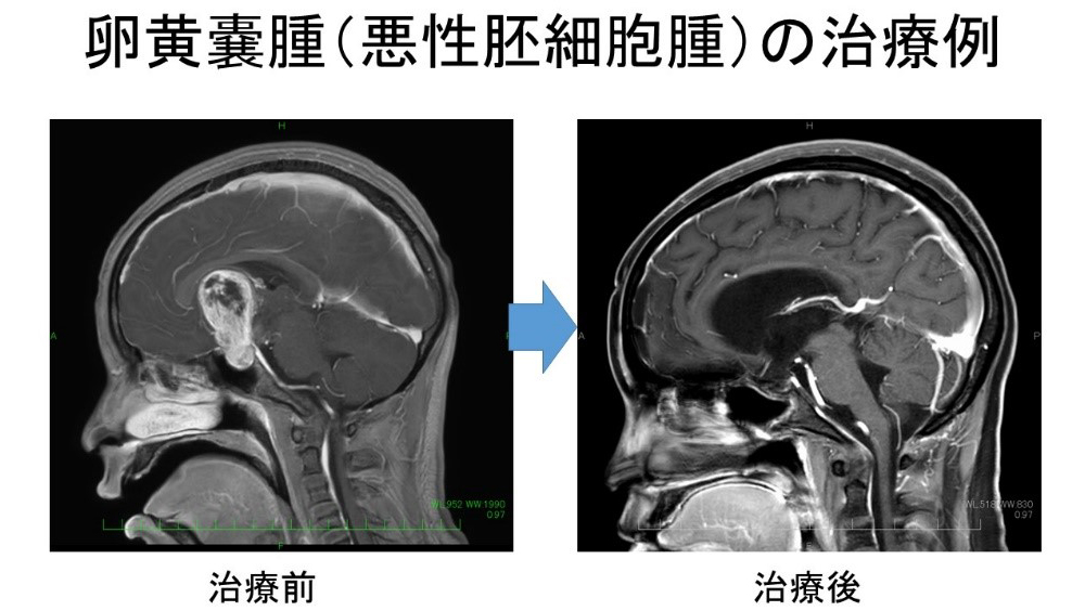 悪性胚細胞腫瘍