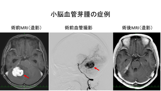 転移性脳腫瘍