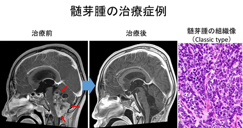 転移性脳腫瘍