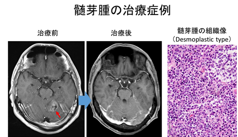 転移性脳腫瘍