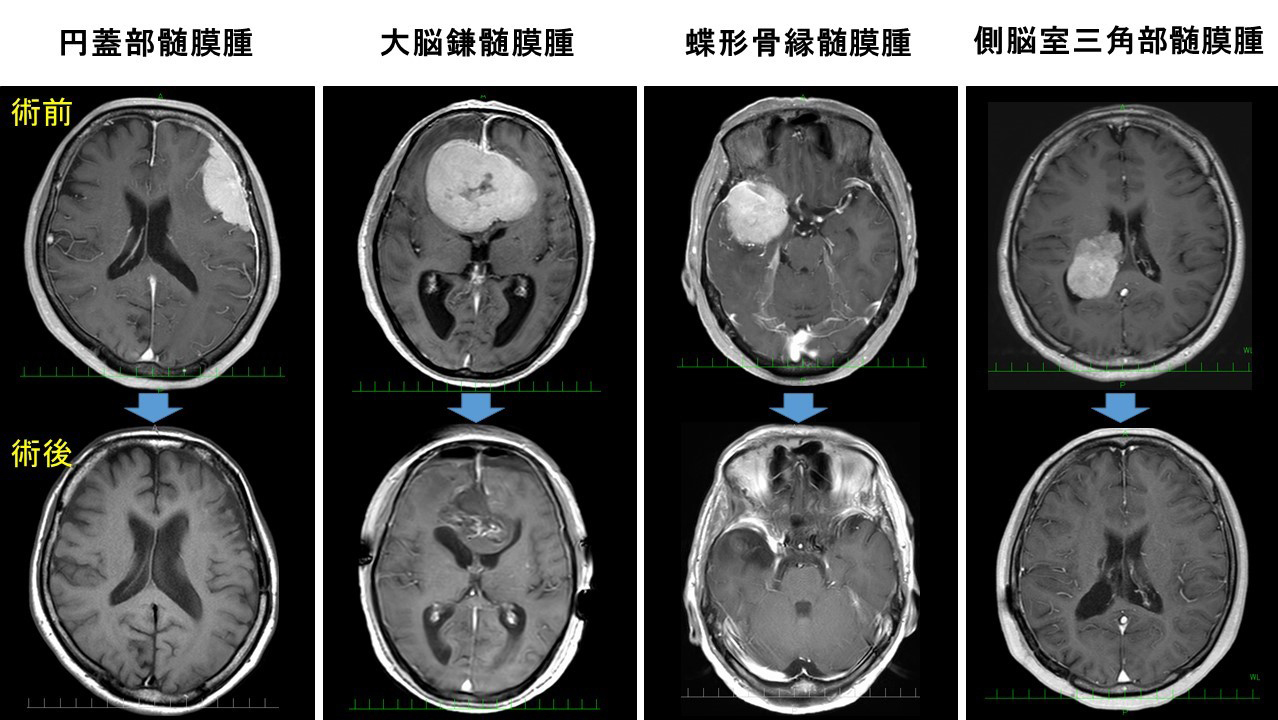 脳腫瘍｜診療内容｜臨床｜神戸大学医学部附属病院 脳神経外科