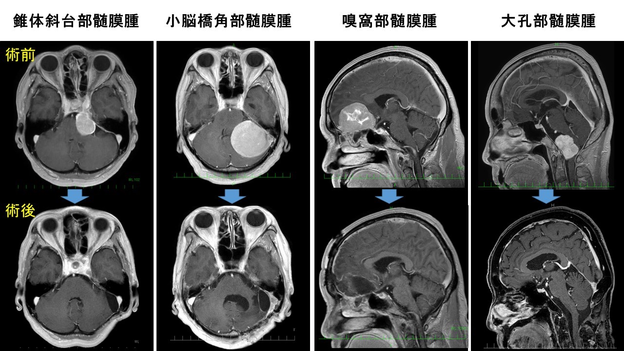 髄膜腫