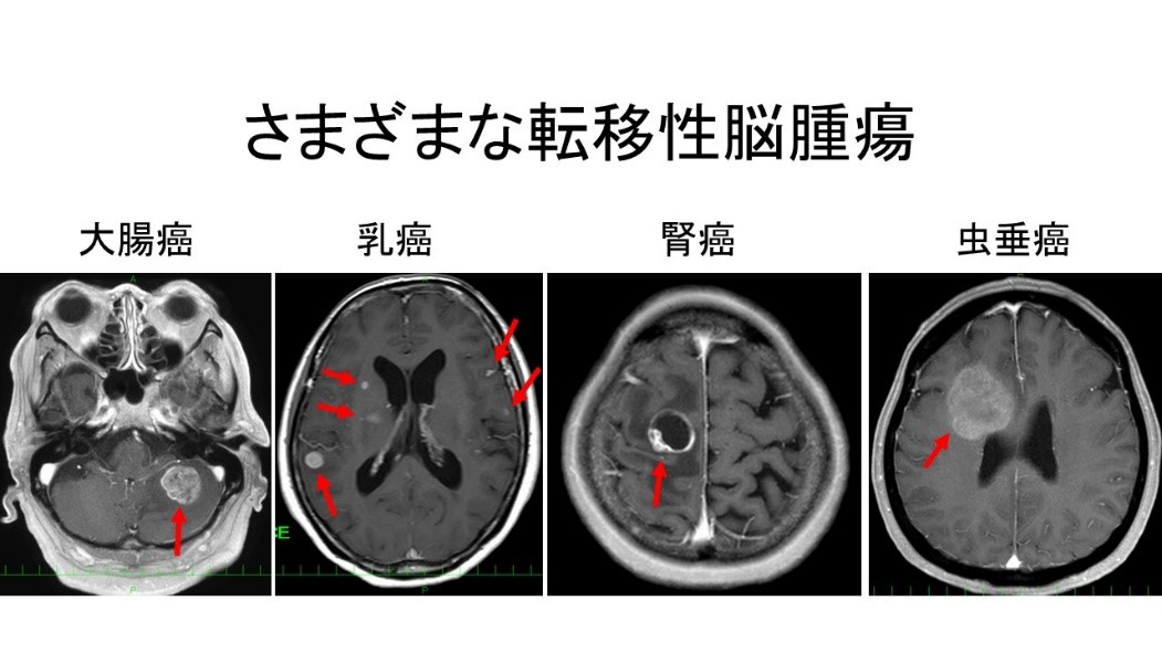 転移性脳腫瘍