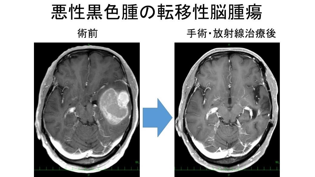転移性脳腫瘍