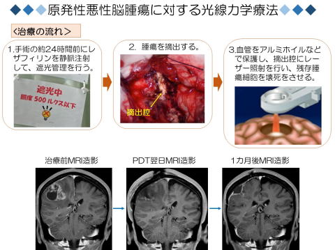 原発性悪性脳腫瘍に対する光線力学療法