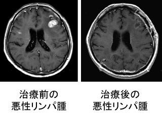 治療前の悪性リンパ腫と治療後の悪性リンパ腫