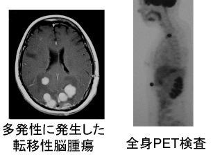 転移性脳腫瘍
