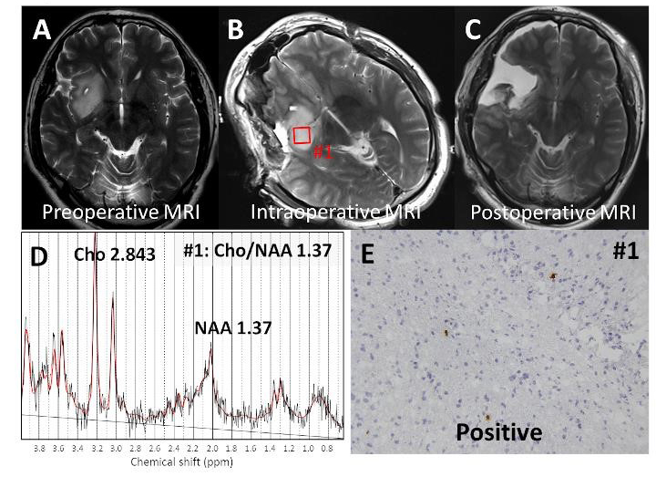 神経膠腫（グリオーマ）の細胞内代謝に関する研究