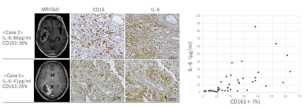 神経膠腫（グリオーマ）の細胞内代謝に関する研究