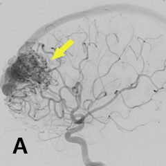 脳動静脈奇形に対する塞栓術
