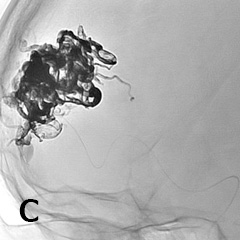 脳動静脈奇形に対する塞栓術