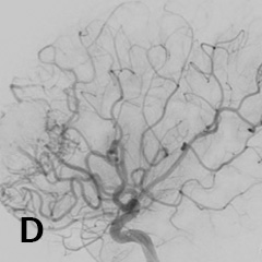 脳動静脈奇形に対する塞栓術