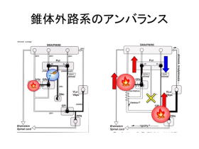 パーキンソン氏病の治療